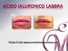 Aumento labbra - Foto del prima - Dott. Erminio Mastroluca M.D.
