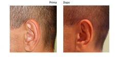 Operazione orecchie (Otoplastica) - Foto del prima - Dott. Riccardo Testa