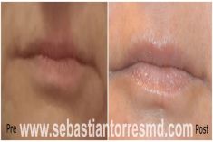 Aumento labbra con Permalip - Foto del prima - Dott. Sebastian Torres Farr