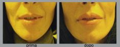 Aumento labbra - Foto del prima - Dott. Luca Leva Chirurgo Plastico