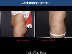 Addominoplastica - Foto del prima - Dott.ssa Chiara Botti