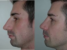 Rinoplastica - Correzione dei difetti della gobba e della punta nasale.