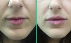 Aumento labbra - Foto del prima - Dott.ssa Moio Mariagrazia