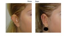 Operazione orecchie (Otoplastica) - Foto del prima - Dott. Riccardo Testa