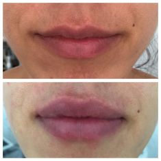 Aumento labbra - Paziente di 34 anni che richiede migliore definizione del labbro superiore e rimpolpamento sia del labbro superiore che inferiore.