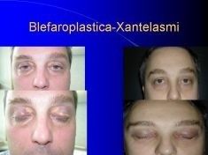 Blefaroplastica - Foto del prima - Dott. Tommaso Savoia Med