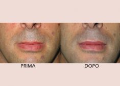 Ingrandimento labbra con grasso (lipofilling) - Foto del prima - Dott. Claudio Cordani