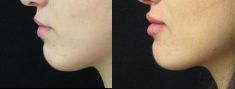 Aumento labbra - Foto del prima - Dott. Aurelio M. Cardaci