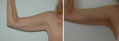 Lifting delle braccia - Brachioplastica con cicatrice nell