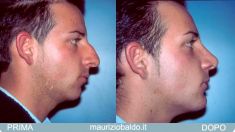Operazione orecchie (Otoplastica) - Foto del prima - Dott. Maurizio Baldo M.D.