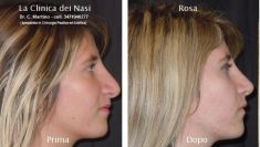 Rinoplastica - Foto del prima - La Clinica dei Nasi - Dott. Carmine Martino C. P.