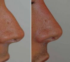Rinoplastica non chirurgica - Rimodellamento del dorso del naso con rinofiller. Si tratta di un trattamento ambulatorio con il ricovero veloce.