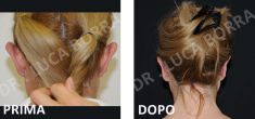 Operazione orecchie (Otoplastica) - Foto del prima - Dr. med. spec. FMH Luca Borra