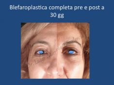 Blefaroplastica - Foto del prima - Dr. Luigi Maria Lapalorcia Specialista in Chirurgia Plastica Ricostruttiva ed Estetica