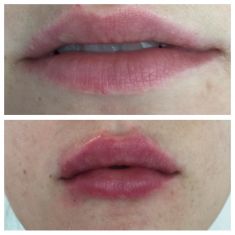 Aumento labbra - Rimodellamento ed incremento volumetrico delle labbra con acido ialuronico specifico per labbra in giovane paziente
