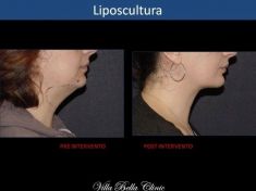 Liposuzione - Foto del prima - Dott.ssa Chiara Botti