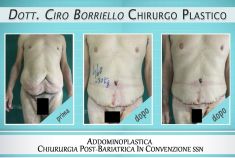 Addominoplastica - Foto del prima - Dott. Ciro Borriello