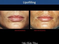 Lipofilling (grasso) - Foto del prima - Dott.ssa Chiara Botti