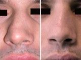 Rinoplastica - Rinoplastica ricostruttiva per deviazione della piramide nasale