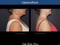 Liposuzione - Foto del prima - Dott.ssa Chiara Botti