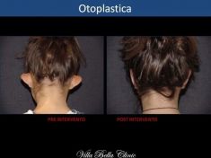 Operazione orecchie (Otoplastica) - Foto del prima - Dott.ssa Chiara Botti
