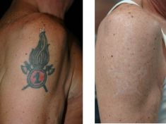Rimozione tatuaggi - laser - Foto del prima - Dott. Aurelio M. Cardaci
