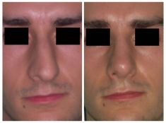 Settoplastica (operazione al setto nasale) - Foto del prima - Prof. Carlo Grassi