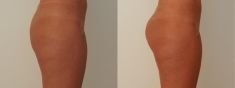 Operazioni di chirurgia plastica glutei - Foto del prima - Prof. Vincenzo Del Gaudio