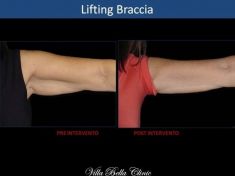 Lifting delle braccia - Foto del prima - Dott.ssa Chiara Botti