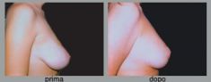 Mastopessi (Lifting seno) - Foto del prima - Dott. Luca Leva Chirurgo Plastico