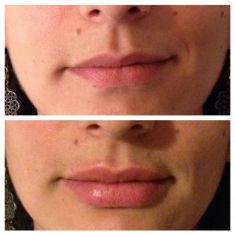 Aumento labbra - Foto del prima - Dott. Andrea Armenti MD, FEBOPRAS