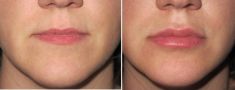 Aumento labbra - Foto del prima - Dott. Aurelio M. Cardaci
