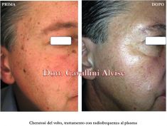 Procedure laser in dermatologia estetica  - Foto del prima - Dott. Alvise Cavallini MD, PhD