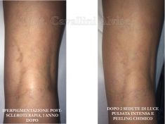 Procedure laser in dermatologia estetica  - Foto del prima - Dott. Alvise Cavallini MD, PhD