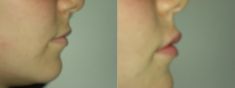 Aumento labbra - Foto del prima - Dr.ssa Maria Luisa Pozzuoli M.D.