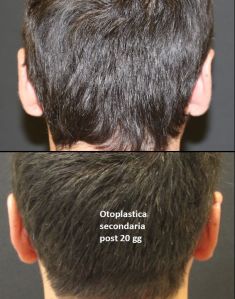 Operazione orecchie (Otoplastica) - Foto del prima - Dott. Aurelio M. Cardaci