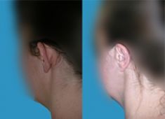 Operazione orecchie (Otoplastica) - Foto del prima - Dott. Arnaldo Paganelli