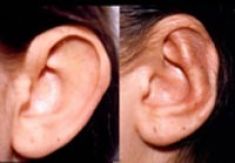 Operazione orecchie (Otoplastica) - Foto del prima