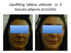 Ingrandimento labbra con grasso (lipofilling) - Foto del prima - Dr. Luigi Maria Lapalorcia Specialista in Chirurgia Plastica Ricostruttiva ed Estetica