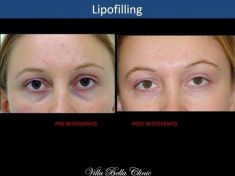 Lipofilling (grasso) - Foto del prima - Dott.ssa Chiara Botti