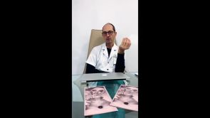 Rughe intorno alla bocca - Dr Uberto Giovannini