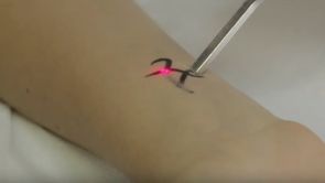 Laser Q-Switched per la rimozione dei tatuaggi