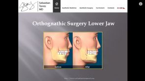 Orthognathic Surgery Lower Jaw