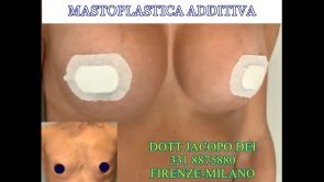 Mastoplastica additiva - Dott. Jacopo