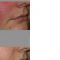 Procedure laser in dermatologia estetica