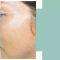 Procedure laser in dermatologia estetica 