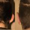 Operazione orecchie (Otoplastica)