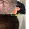 Trapianto capelli