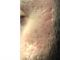 Acne laser, Cicatrici da acne laser