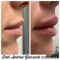 Filler antirughe a base di acido ialuronico